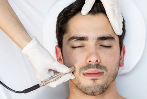 Tratamiento de acné con meso terapia