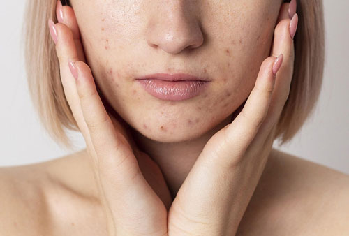Tratamiento de manchas y acne