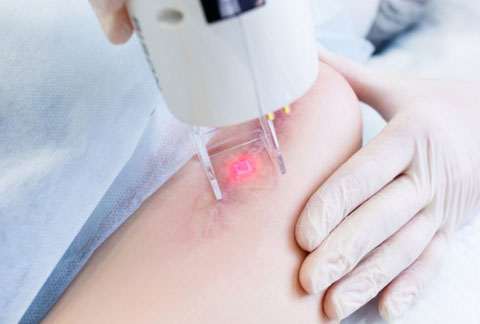 tratamiento de cicatrices con laser